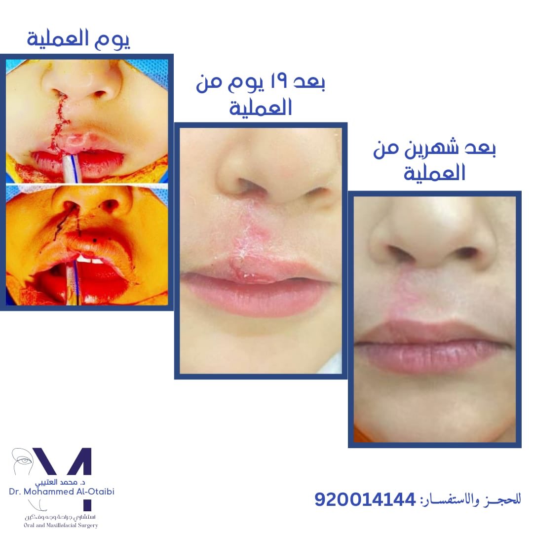 |Cleft lip repair

#cleft #cleftlip #cleftpalate #cleftlipandpalate #Riyadh