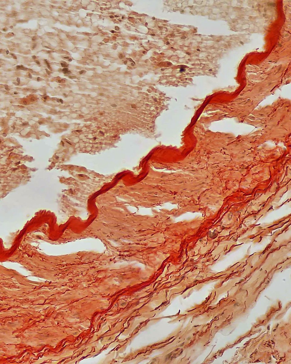 olkazuraw's tweet photo. Exploring the artistic aspect of special stains.

This is an artery stained with Congo Red.

I love the pattern the internal elastic membrane makes.

#microscopicphotography #pathart #specialstains #digitalart #nftart 
#Ilovehistology #Ilovepathology #digitalpathology #dppart https://t.co/1F9gDEkRf5