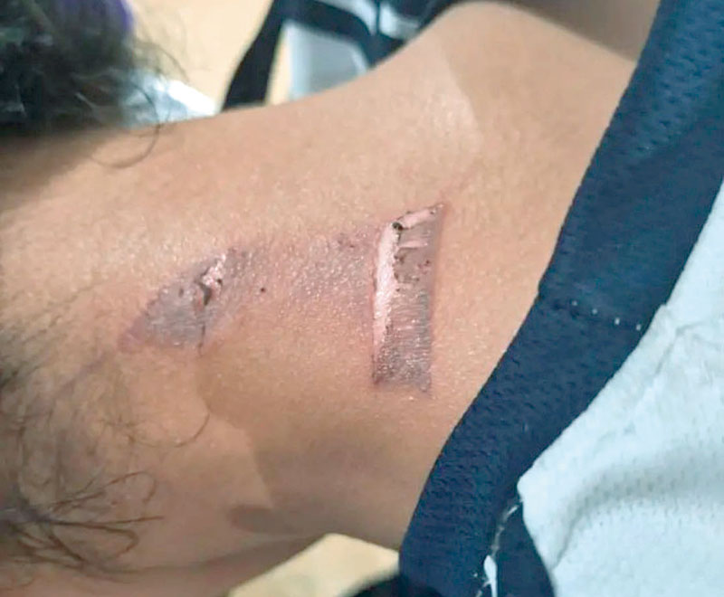 NOTIVER's tweet photo. LE #PROVOCAN #QUEMADURA A #ESTUDIANTE
#BULLYING EN LA #ESTI1
#madre #denunció que #hijo fue #víctima de bullying 
de #Veracruz, ya que uno de sus #compañeros le #provocó #quemadura de #segundo #grado con #cutter entre la #nuca y la #yugular
https://t.co/WCtAogBM41 https://t.co/9qQn6H5j44