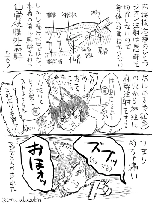 痔の手術レポです