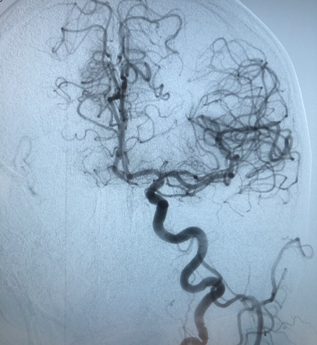 80yo M with M1 LMCA occlusion after 48hrs break in DOAC treatment(FAP) due to planned CRT implantation. NIHSS 23, MT: ASP+SR-DAC Catalyst 6, SR TrevoNXT4x41, 1pass, TICI3. In TEE‘sludge’ and small thrombus in LAA. Qualified to LAAC in 3weeks. #heartbrainteam #neurotwitter