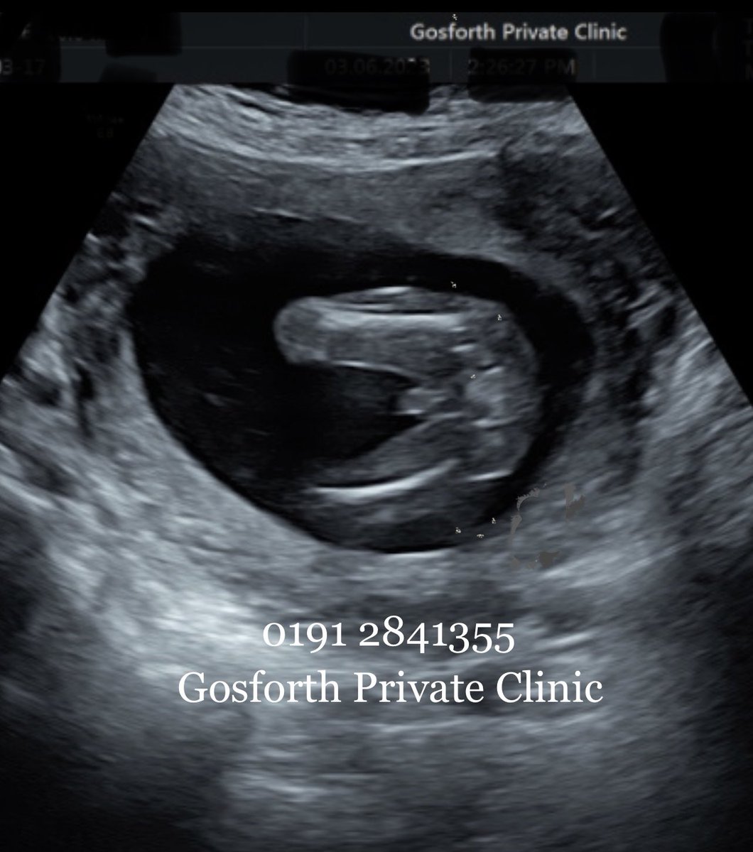 GosforthClinic's tweet photo. 💙Its a BoY!! Find out withOur 4D GenderScan - £59
🛜https://t.co/N2MFhExqWq 📲0191 2841355
#babyscan #pregnancy #ultrasound #datingscan #4dscan #baby #pregnant #genderreveal #babygirl #babyboy #gender #scan #boyorgirl #babyshower #Newcastle #twins #heartbeat #Saturday #Weekend https://t.co/vy8uH1Nj7J