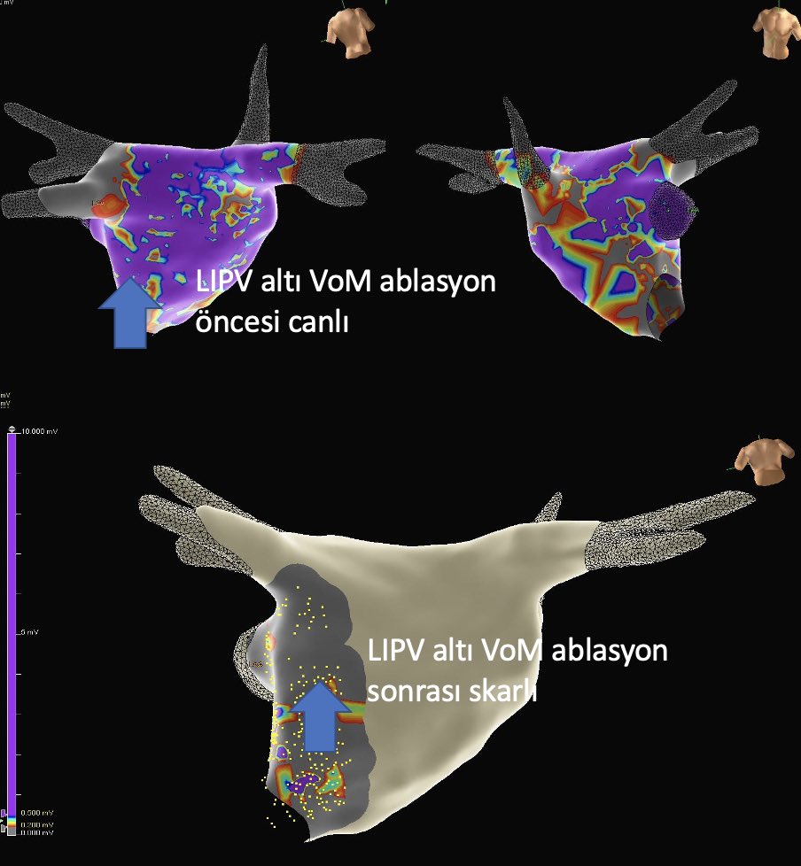 mertilkerh's tweet photo. First experience with VoM ablation 
Before and after 
#CardioTwitter #EPeeps https://t.co/5wxGySZhga