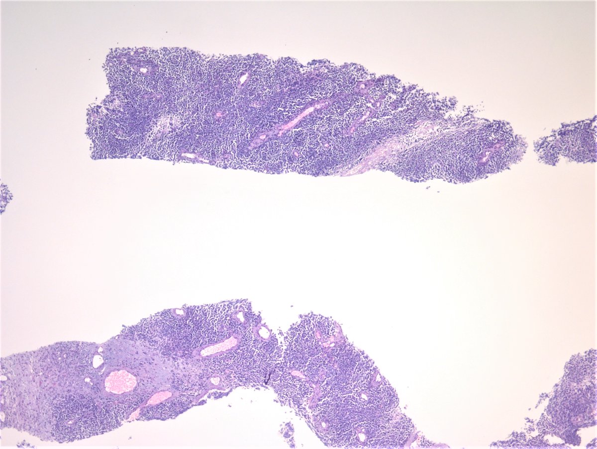 MirunaPopescu13's tweet photo. Another morphological quiz🧩- enlarged lymph node, biopsy
What's your DDx based on morphology alone? 🔬
Any stains you'd like to order? 🎨

Answer along with #IHCPath will be posted on KiKo shortly.

Colleague's case 🙏🏽

#PathTwitter #LNpath #pathresidents #HEpathology https://t.co/BHcmteZyxC
