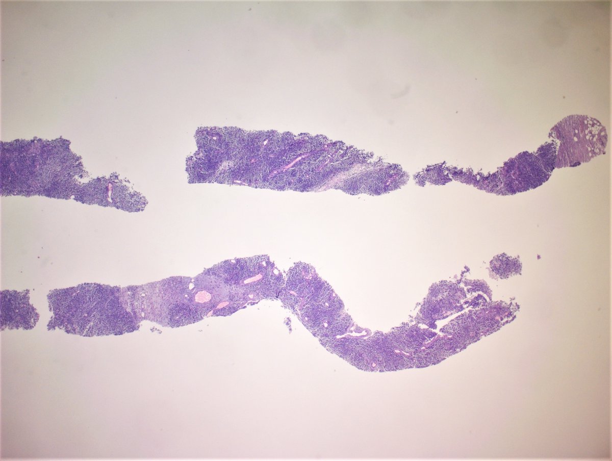 MirunaPopescu13's tweet photo. Another morphological quiz🧩- enlarged lymph node, biopsy
What's your DDx based on morphology alone? 🔬
Any stains you'd like to order? 🎨

Answer along with #IHCPath will be posted on KiKo shortly.

Colleague's case 🙏🏽

#PathTwitter #LNpath #pathresidents #HEpathology https://t.co/BHcmteZyxC