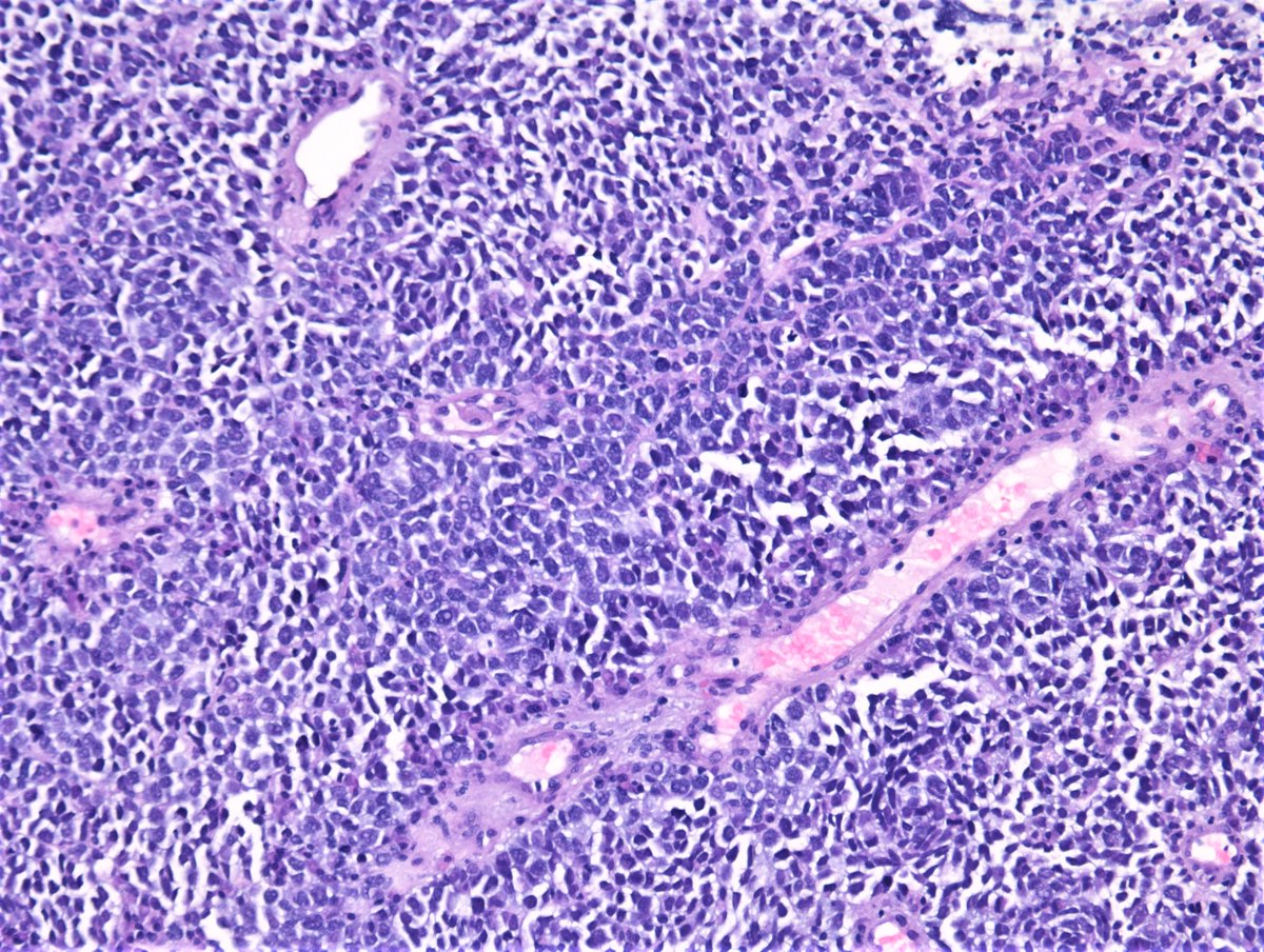 Another morphological quiz🧩- enlarged lymph node, biopsy
What's your DDx based on morphology alone? 🔬
Any stains you'd like to order? 🎨

Answer along with #IHCPath will be posted on KiKo shortly.

Colleague's case 🙏🏽

#PathTwitter #LNpath #pathresidents #HEpathology