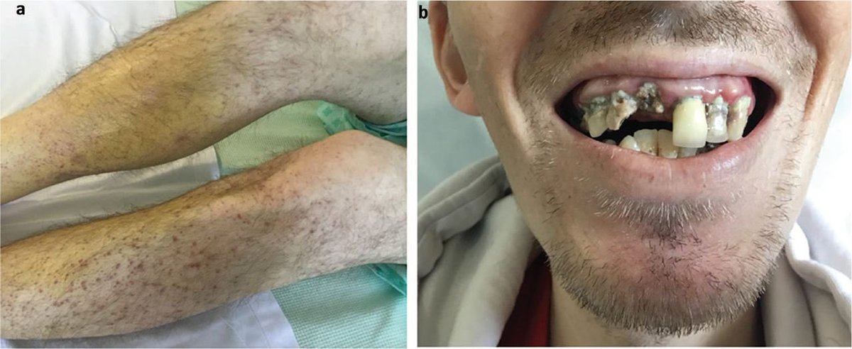 Patient presents with leg pain and rash with normal platelet count. What’s the diagnosis?