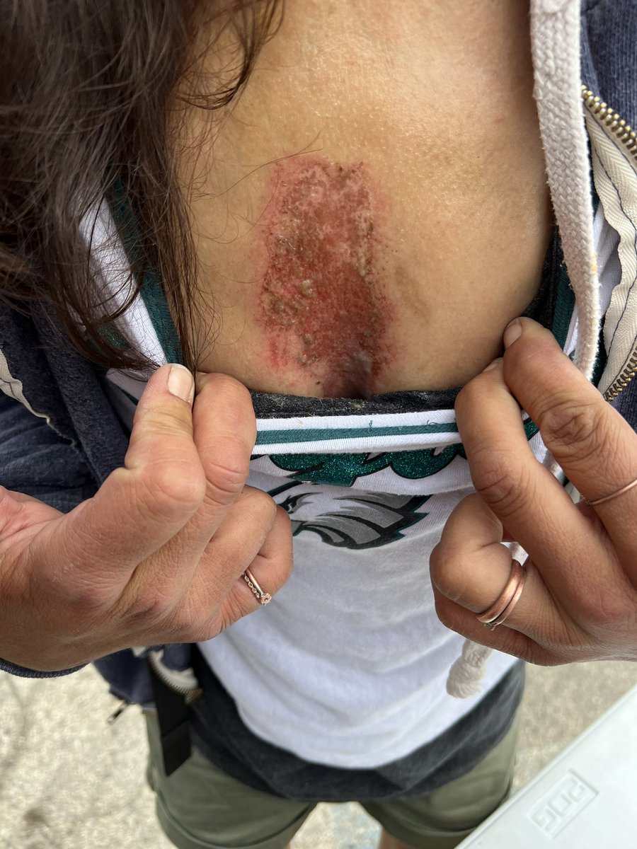 PSA: Sternum rubs do not reverse overdoses. They are a tool to see if someone is alert. Administering a sternum rub for too long/hard incorrectly can harm someone. 

Pic: