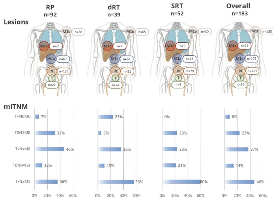 PSMA PET findings in an “EMBARK-like” cohort of pts with high-risk #nmHSPC: a single center posthoc retrospective analysis. Presented by Wesley Armstrong <a href="/uclacaltechmstp/">UCLA-Caltech MSTP</a>. #ASCO23 written coverage by <a href="/zklaassen_md/">Zach Klaassen</a> <a href="/GACancerCenter/">Georgia Cancer Center</a> &gt; bit.ly/45CFtHM <a href="/ASCO/">ASCO</a>