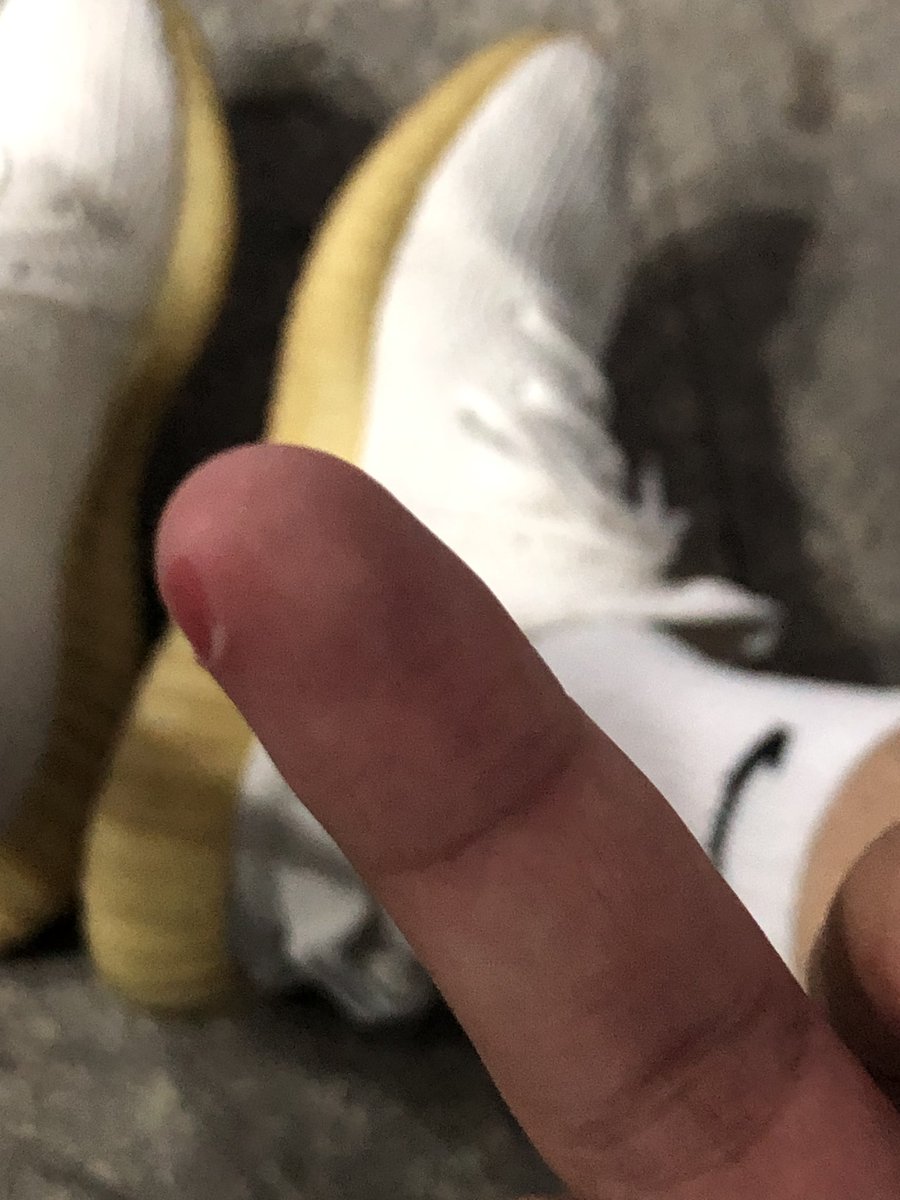 打球受伤的倒霉蛋