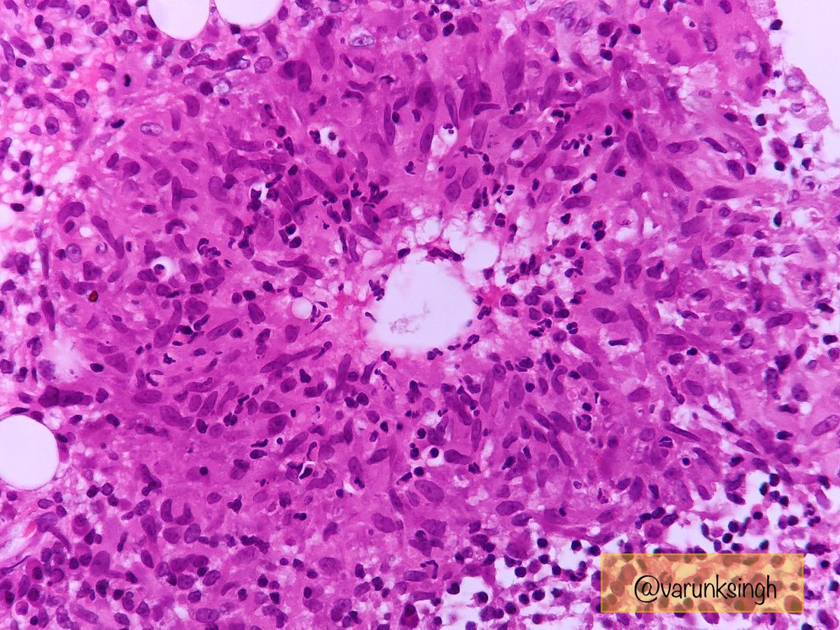 A cancer mimic🎭
➡️Painful breast lump in a 35yr/F
➡️Central vacuole surrounded by epithelioid histiocytes, admired neutrophils, giant cells
➡️AFB/PAS/GMS/Gram’s -ve
➡️Autoimmune serology -ve
Probably — Idiopathic granulomatous mastitis
#PathTwitter #MedTwitter #pathresidents