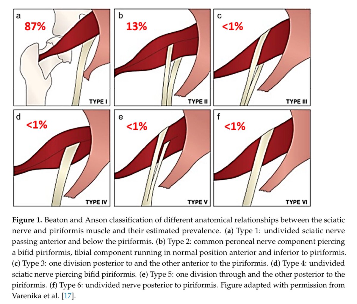 Retlouping's tweet photo. Variant Sciatic Nerve Anatomy in Relation to the Piriformis Muscle on Magnetic Resonance Neurography: A Potential Etiology for Extraspinal Sciatica https://t.co/ckwKvZetYU https://t.co/kquABn4izB