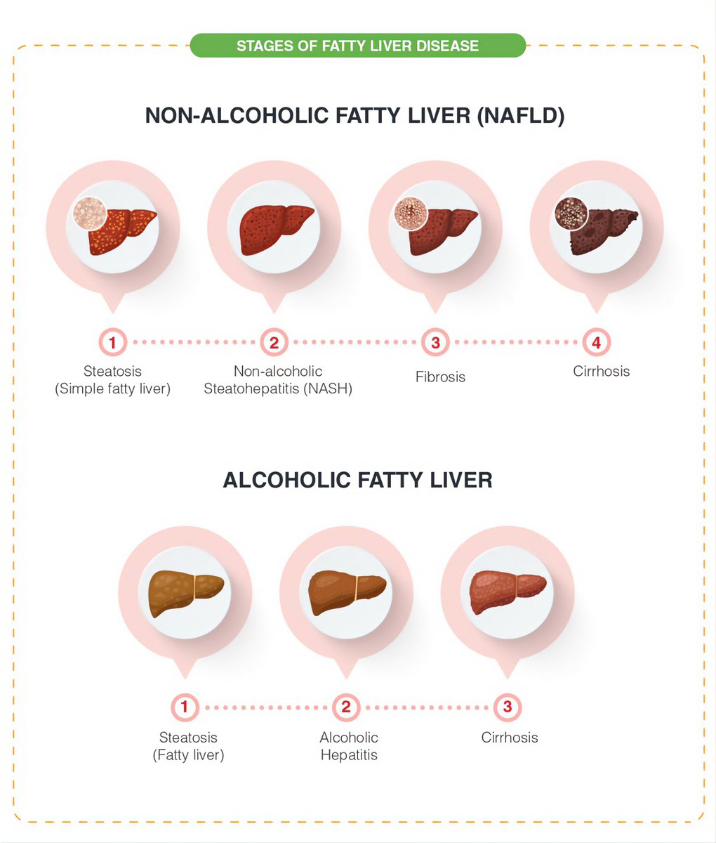 Stages of liver disease ⚠️