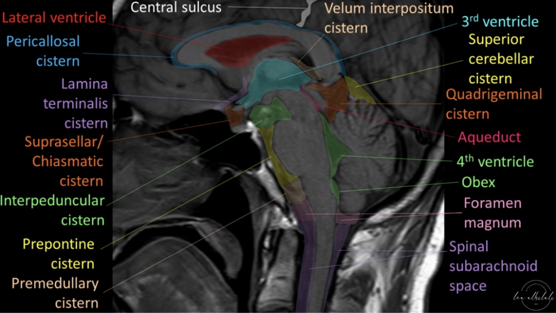 Sink or swim! 

Brain is swimming in CSF. CSF is key for protection, buoyancy, & hormone & waste transport 

Most know basic ventricular anatomy well, but not subarachnoid anatomy. But it's important for safe nsgy navigation

#Neurosurgery #neurotwitter #neurorad #meded #radres