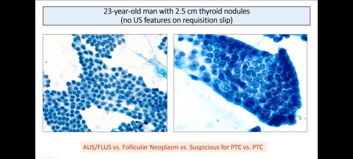 Excellent educational opportunity to learn about Algorithmic Approach to Thyroid FNA by Dr. Baloch.Thank you for an amazing session.#Endopath @aakasharmand @PathElective @KMirza 
#pathmatch2024
pathelective.com/cytopath-2
link to lecture