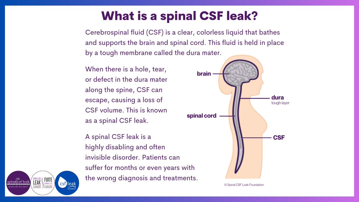 spinalCSFleak's tweet image. Welcome to #LeakWeek, our annual awareness week for spinal CSF leak! Join us w @SpinalCSFCanada &amp;amp; @csfleakuk as we raise awareness about this debilitating condition. First up: What is a spinal CSF leak? 

#leakweek2023 #spinalcsfleak #becauseyourduramaters