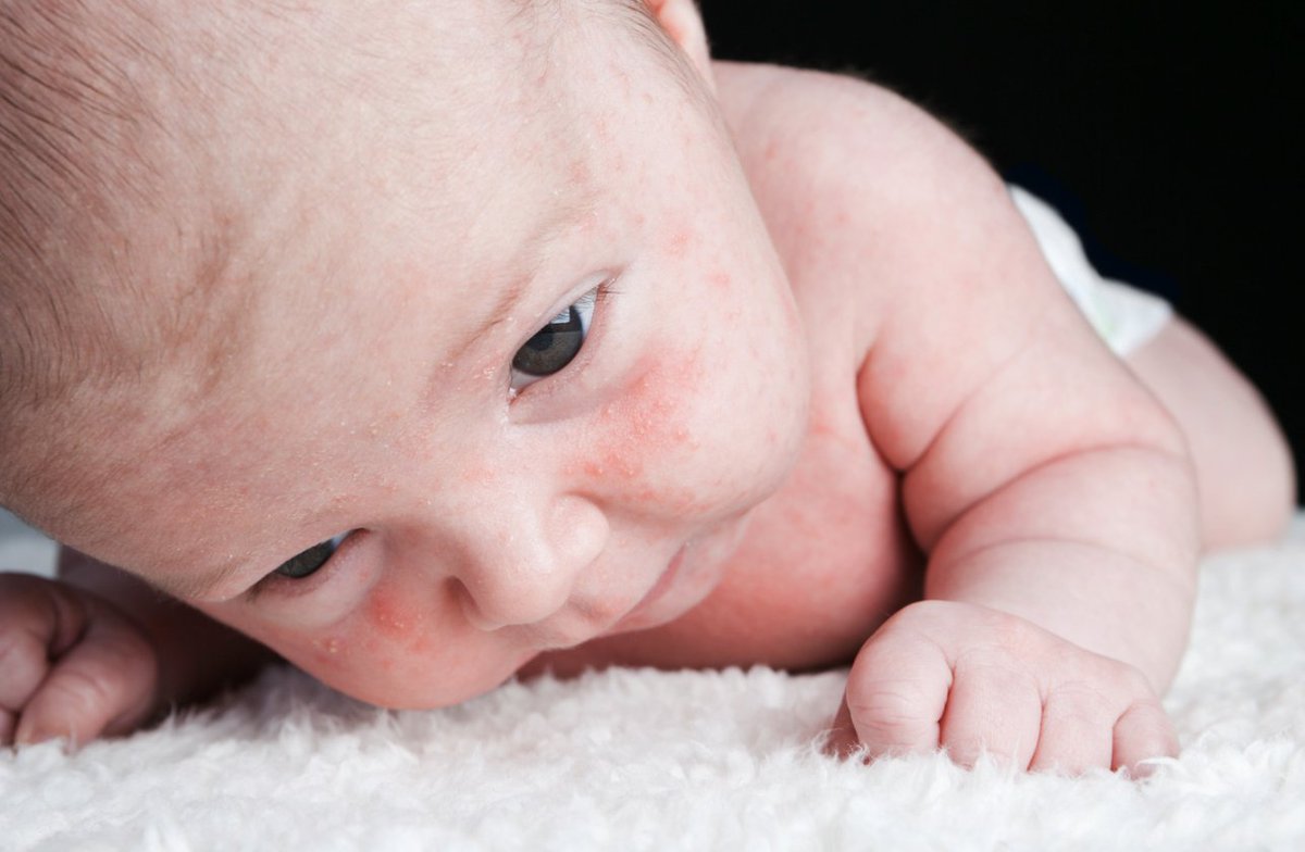 Fascinating research indicates that the immune and lipid profiles on infants' skin surfaces can predict future allergic conditions like atopic dermatitis or eczema. 
#parents #ParentsToolkit #health #news #today #Trending #Now