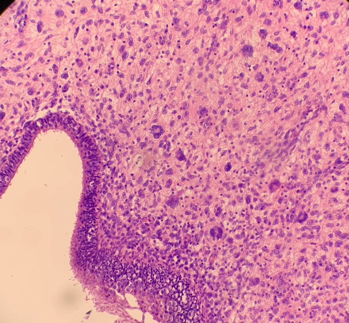 38 years-old woman,
Intramural uterine mass,
#PathTwitter #GynPath