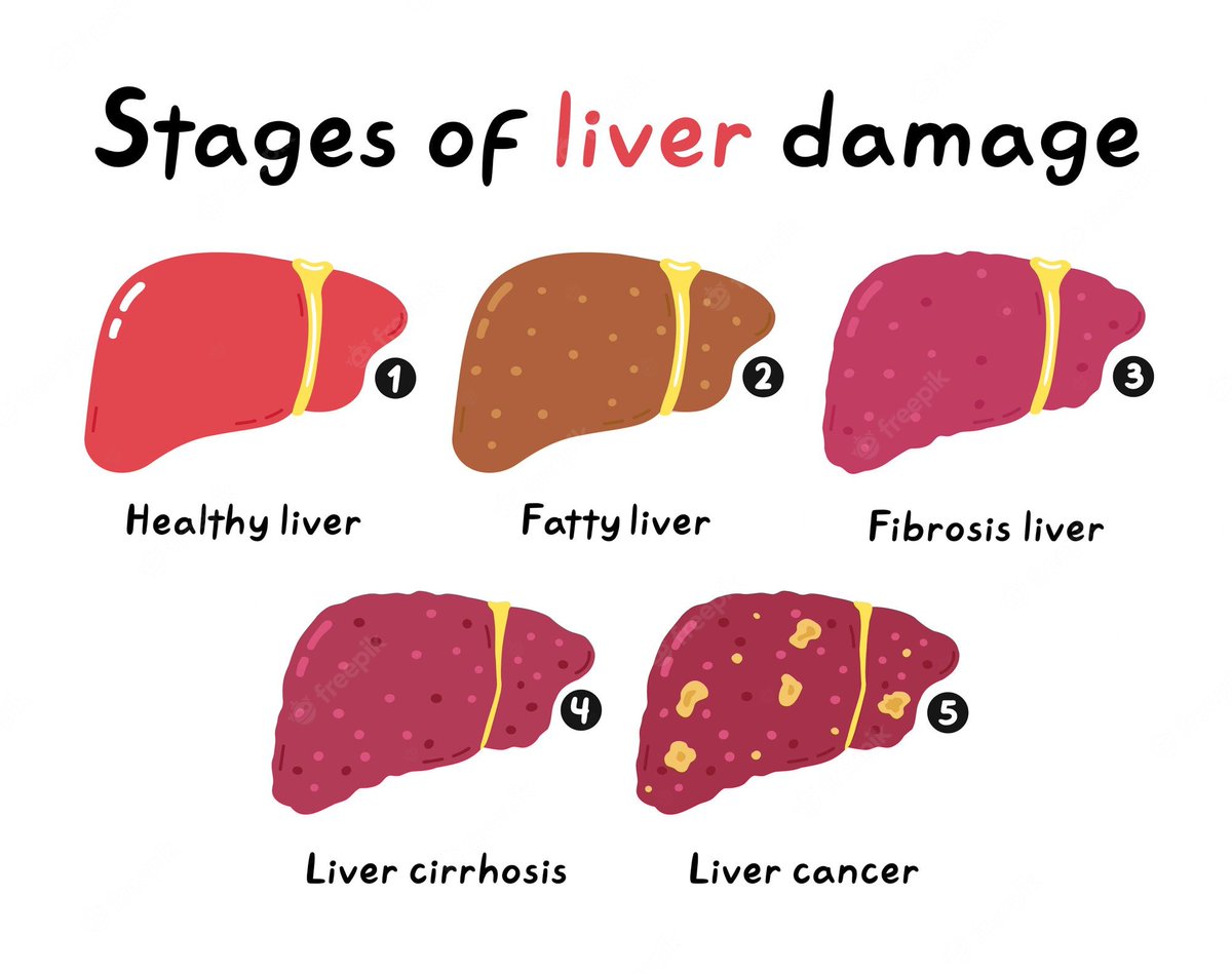 These conditions usually progress from fatty liver to alcoholic hepatitis to cirrhosis, although heavy drinkers may develop alcoholic cirrhosis without first developing hepatitis.