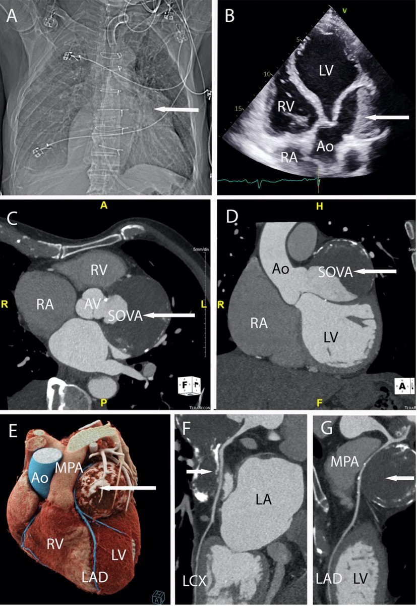 Hellenic Journal of Cardiology (@hjcardiology) on Twitter photo Image of the Month
Sinus of Valsalva #aneurysm as a cause of #ischemia & functional MVR-related #cardiomyopathy
<a href="/HjCardiology/">Hellenic Journal of Cardiology</a> bit.ly/giantSoVA
<a href="/HCSgr/">HCS</a> <a href="/hjc_ed/">HJC Editor-in-Chief</a> <a href="/rajani_dr/">Ronak Rajani</a> #coronary #AorticValve #MitralValve #EchoFirst #CardioTwitter Image of the Month
Sinus of Valsalva #aneurysm as a cause of #ischemia & functional MVR-related #cardiomyopathy
<a href="/HjCardiology/">Hellenic Journal of Cardiology</a> bit.ly/giantSoVA
<a href="/HCSgr/">HCS</a> <a href="/hjc_ed/">HJC Editor-in-Chief</a> <a href="/rajani_dr/">Ronak Rajani</a> #coronary #AorticValve #MitralValve #EchoFirst #CardioTwitter