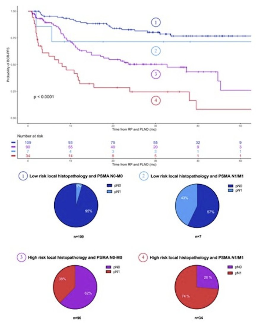 Pre-surgical 68Ga-PSMA-11 PET for biochemical recurrence risk assessment: a surrogate of pelvic lymph node dissection? Follow-up analysis of a multicenter prospective phase 3 imaging trial. Presented by <a href="/DjailebLoic/">Djaïleb Loïc</a> <a href="/UCLATheranostic/">UCLA Theranostics</a> &gt; bit.ly/45OjzBF <a href="/zklaassen_md/">Zach Klaassen</a> #ASCO23