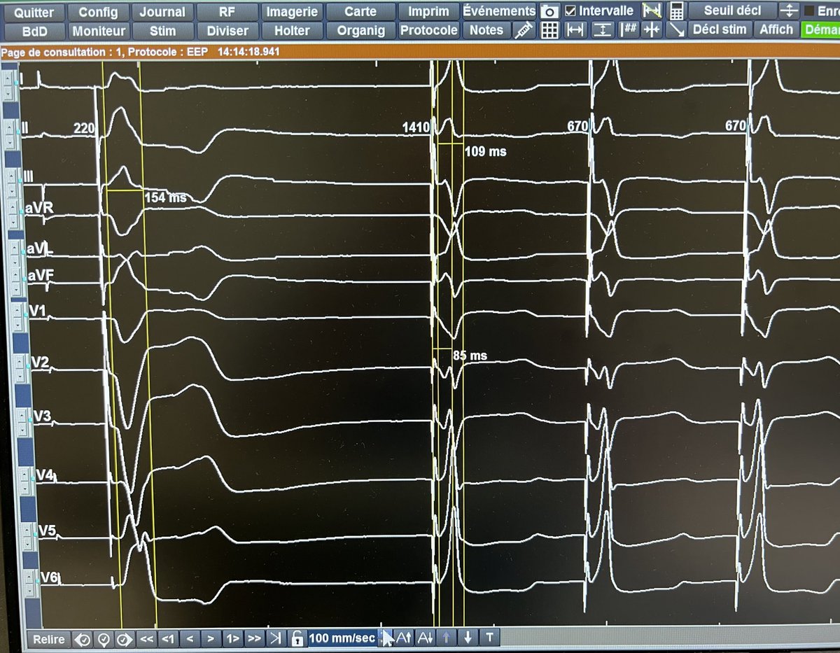 EPWaveDoc's tweet photo. Different QRS morphologies of septal versus transseptal/LVFP in pat w AVB after #Bentall procedure. Poor man’s #LBBAP #CSP w Tendril w/o sheath support. #Epeeps @drjohnm @curilakarol @kvernooy @Hisdoc1 @Marek_Jastrz_EP @OCanoPerez @drpmoskal @clementy_ep @HaranBurri @MdHuang https://t.co/jD8NcRw8Uk