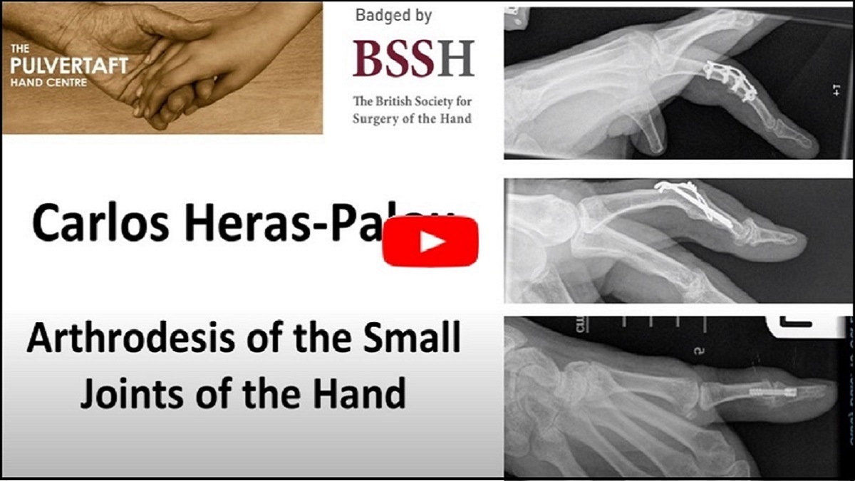 ipokrate's tweet photo. Arthrodesis of the Small Joints of the Hand

Watch the Pulvertaft Videos series on "Indications, options and techniques for arthrodesis of the interphalangeal joints of the hand and the metacarpophalangeal of the thumb." 

https://t.co/Lv3GG4mjyH

#ipokrate #conference #doctor https://t.co/SEf65wMhoB