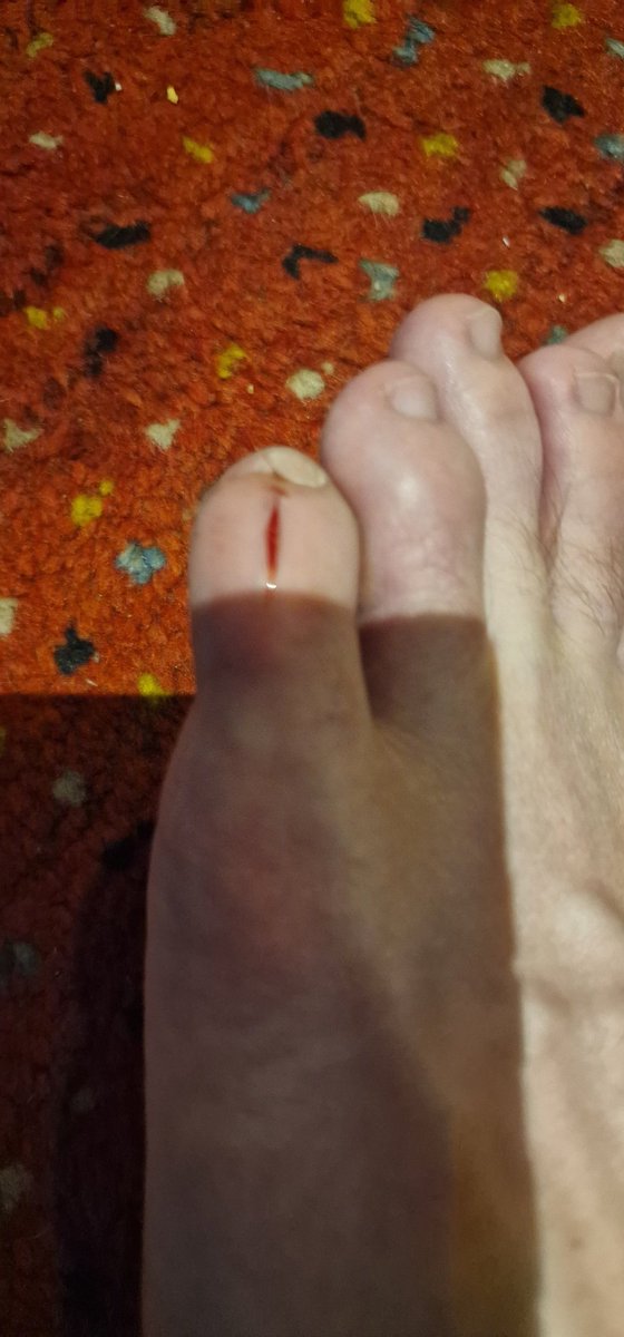 Colster79's tweet image. Avoid @JDSports in @heathrowairport terminal 5. Injured on one of the chairs ripping my shoe and cutting my little toe. The staff didn't offer me any first aid or accident book and didn't have any tissue to wipe my blood off their floor. #poorservice #nofirstaid #didnthelp #avoid