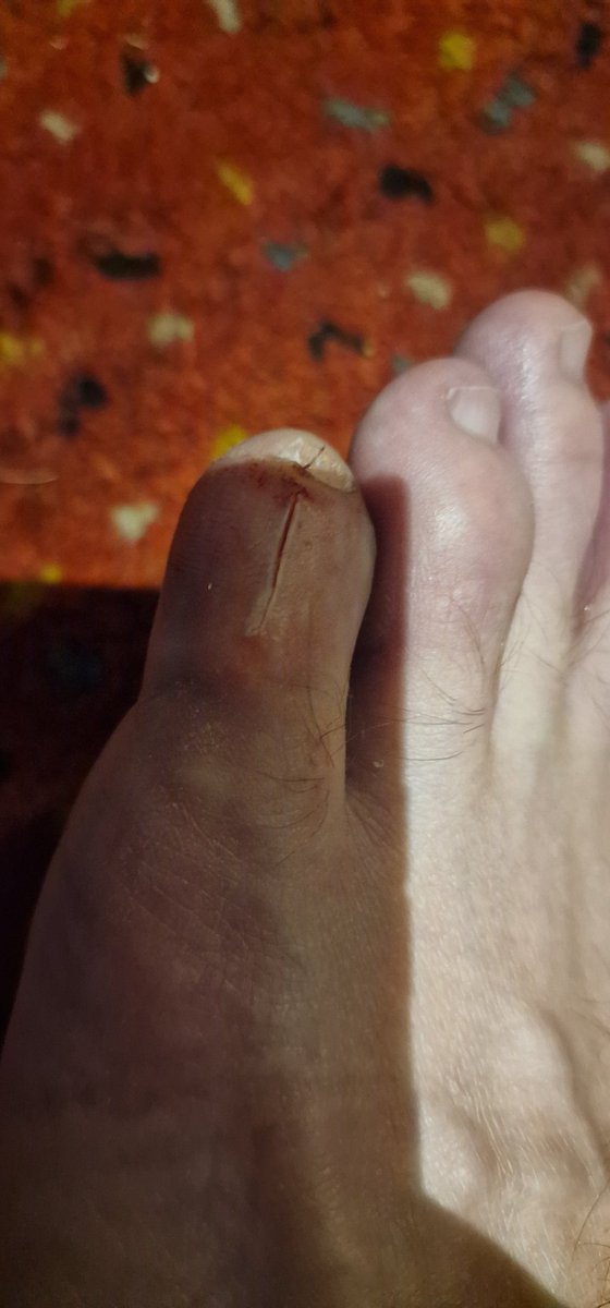 Colster79's tweet image. Avoid @JDSports in @heathrowairport terminal 5. Injured on one of the chairs ripping my shoe and cutting my little toe. The staff didn't offer me any first aid or accident book and didn't have any tissue to wipe my blood off their floor. #poorservice #nofirstaid #didnthelp #avoid