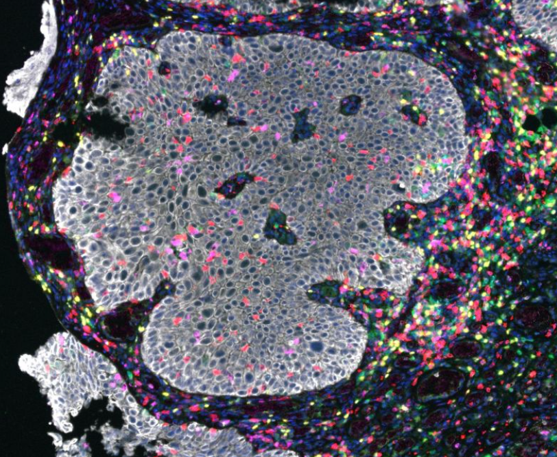 UoS_Oncology's tweet photo. The use of pan-cancer gene expression analysis with @AkoyaBio multiplexed immunofluorescence on #NonMuscleInvasiveBladderCancer FFPE tissue ...1/3 https://t.co/4m8gtJD3Ib