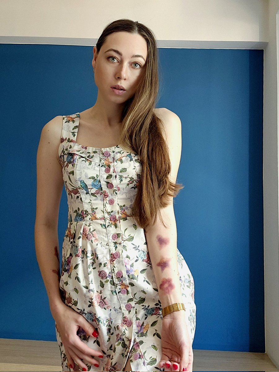 Join our bruises campaign to make a change for all VWD patients in Europe. Drop me a message to know how you can be involved.
#vwdunited #vwdtogethere #bevwdaware
<a href="/EHC_Haemophilia/">EHC_Haemophilia</a>