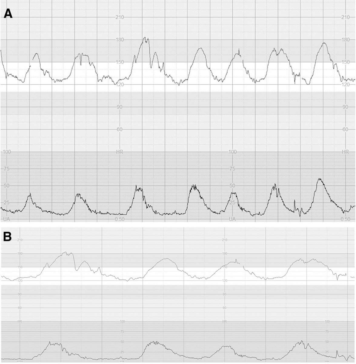 AJOG Expert Review:  Pathophysiological interpretation of fetal heart rate tracings in clinical practice - double mountain peak sign - erroneous recording of the maternal HR as FHR. ow.ly/2ZB050OR0fS