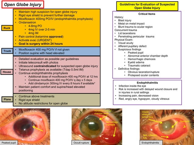 @OGdukeneurosurg Open globe injury showing tear drop pointing to the injured corneal. The pupil has an irregular, teardrop shape because a piece of penetrated injury to the patient’s cornea and the iris prolapsed through this corneal defect.
Tx shield the eye to prevent further injury