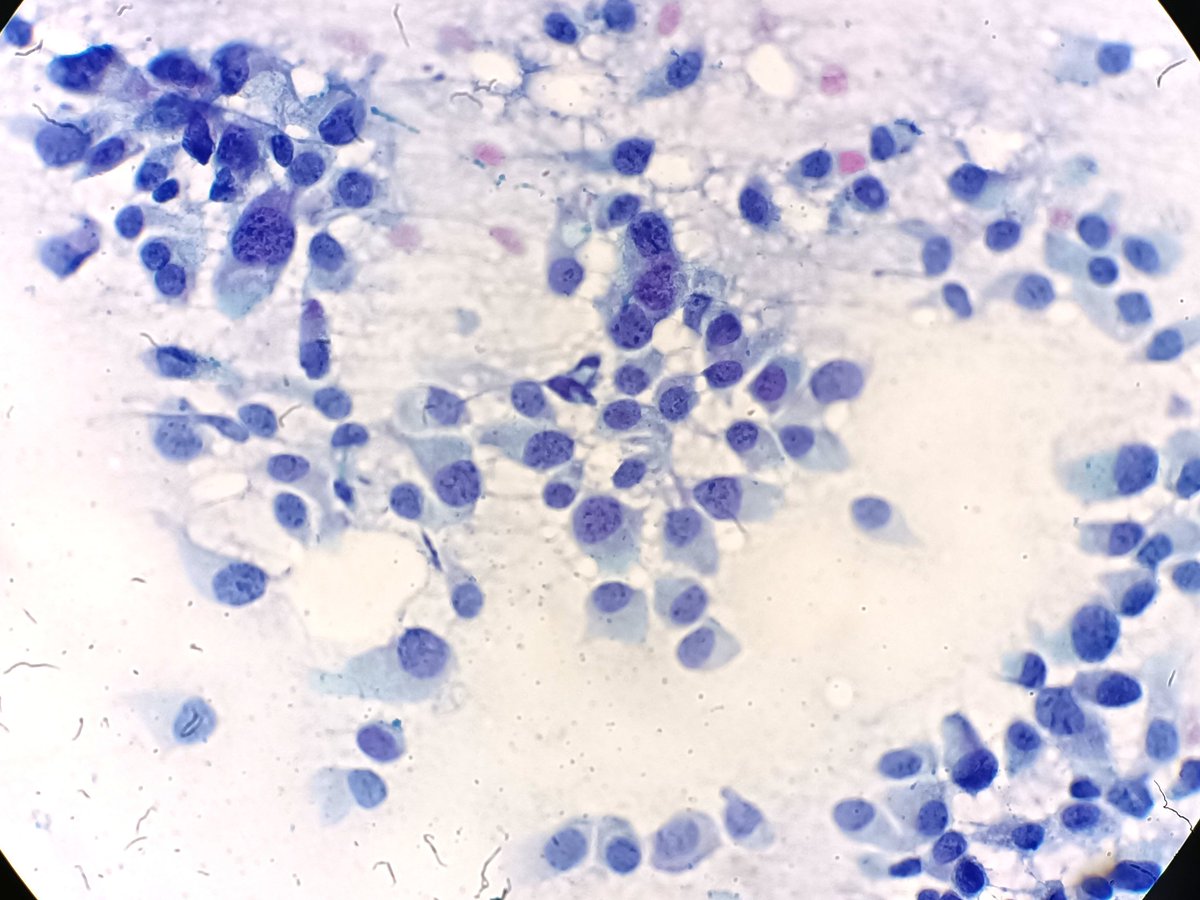 🟢FNA from an axillary lymph node. 63 year old woman. #thepoweroftheneedle #cytology #PathTwitter