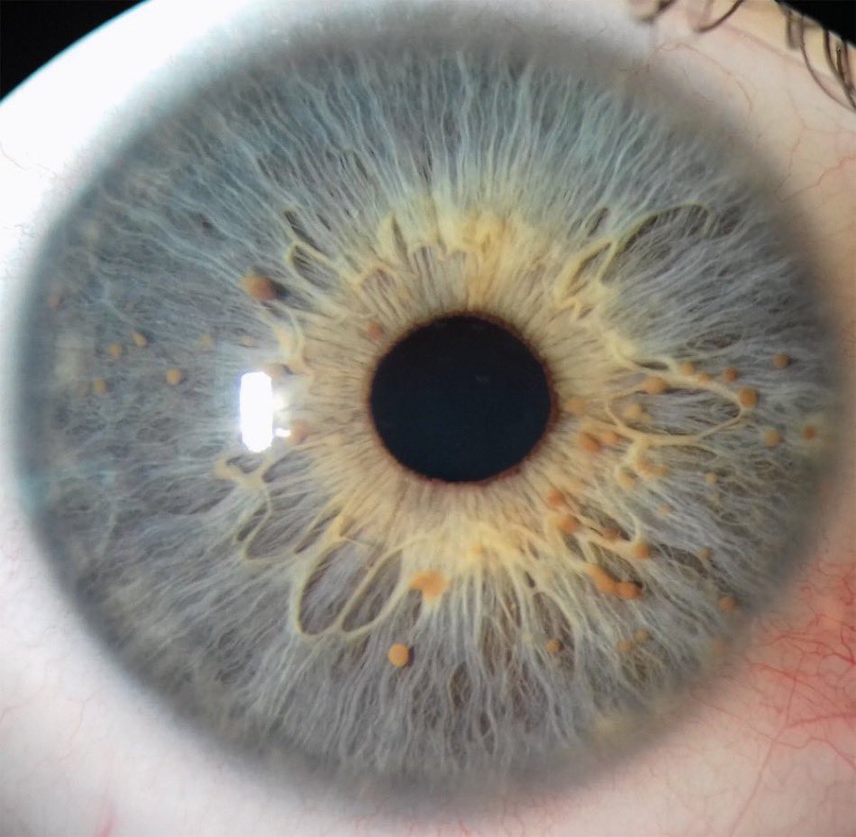Eye of a patient with colonic polyps. What’s the diagnosis? H/t @drkeithsiau #medtwitter
