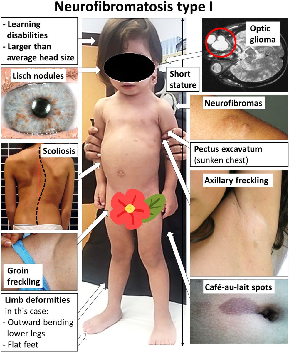 @BrownJHM @drkeithsiau 💠Neurofibromatosis type 1 (NF1).
✅Dx:
1️⃣A genetic condition causes tumors to grow along nerves.
2️⃣The tumors usually benign.
3️⃣NF2 much less common than NF1.
4️⃣Benign eye tumors (Lisch nodules grow on the iris).
@IhabFathiSulima 
⤵️