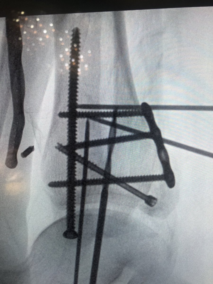 InvictaOrtho's tweet photo. A lateral view ankle showing setup of two medial mal screws. One screw already in the anterior colliculus and the other one is set up to be in the inter collicular groove. The red area should be avoided, or bury it to ensure screw head doesn’t rub on posterior tib tendon. https://t.co/wUQI81Mkkj