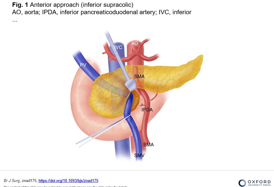 Artery-first approach in pancreatic surgery - choose the best approach based on tumour location and vessel involvement: anterior (inferior supracolic) mesenteric (inferior infracolic) superior right/left posterior medial uncinate Check academic.oup.com/bjs/advance-ar… for more tips!