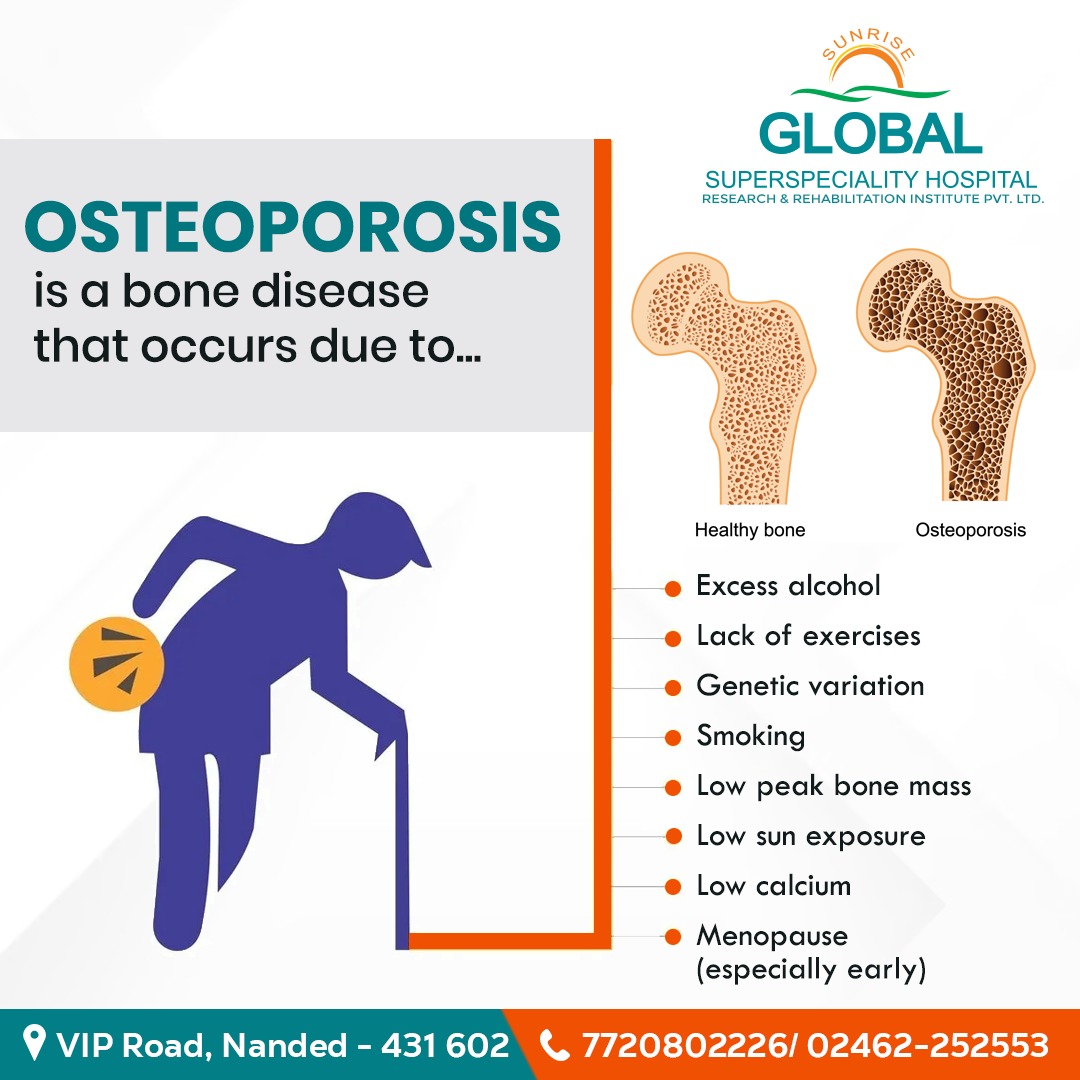 Call 7720802226 or 0246225255 to book an
appointment now.
#osteoporosis #patahtulang #osteoarthritis #health #bonehealth #diabetes #osteoporosisprevention #sunriseglobalhospital #multispecialityhospital #nanded