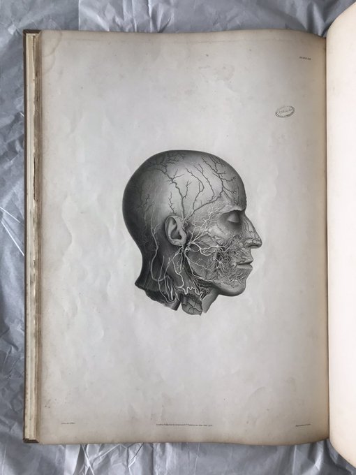 stroke2023event's tweet image. Stroke is a leading cause of death and disability worldwide. Getting fast access to quality stroke treatment saves lives and improves outcomes for survivors.#RETWEEETMEPLEASE #visit