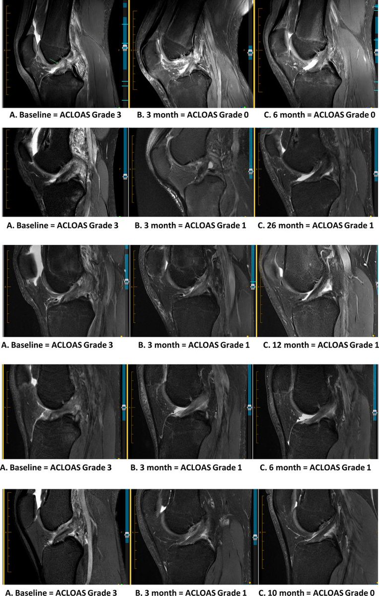 📣 NEW #OriginalResearch 📄 

90% patients with complete #ACL rupture showed signs of ACL continuity at 3 months on MRI when using the Cross Bracing Protocol

This #OpenAccess article describes the impact this may have on future research and practice

👉 bit.ly/3qQAjbl