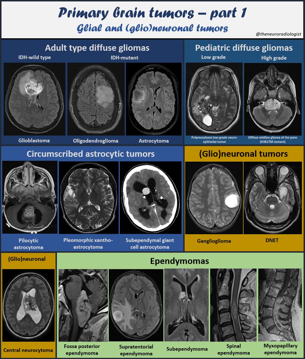Glial tumors constitute the most frequent primary brain tumors in both adults and children. Radiological overview of the various gliomatumor categories according to the latest WHO 2021 classification. Non-exhaustive overview. #MedTwitter #NeuroTwitter #MedEd #Radres