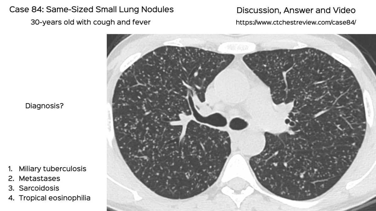 Case 84: Same sized small lung nodules

30-years old with cough and fever

Diagnosis?

1. Miliary TB
2. Metastases
3. Infectious bronchiolitis
4. Trop pulm eosinophilia

Discussion video

ctchestreview.com/case84/

#chestrad #ctchest #FOAMrad #radres #lungnodules