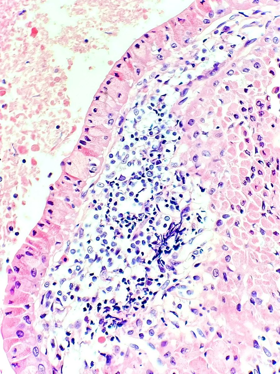Fine needle aspiration cell block of what type of salivary gland tumor? Answer: kikoxp.com/posts/14917 #PathArt #CytoPath #PathTwitter #MedTwitter