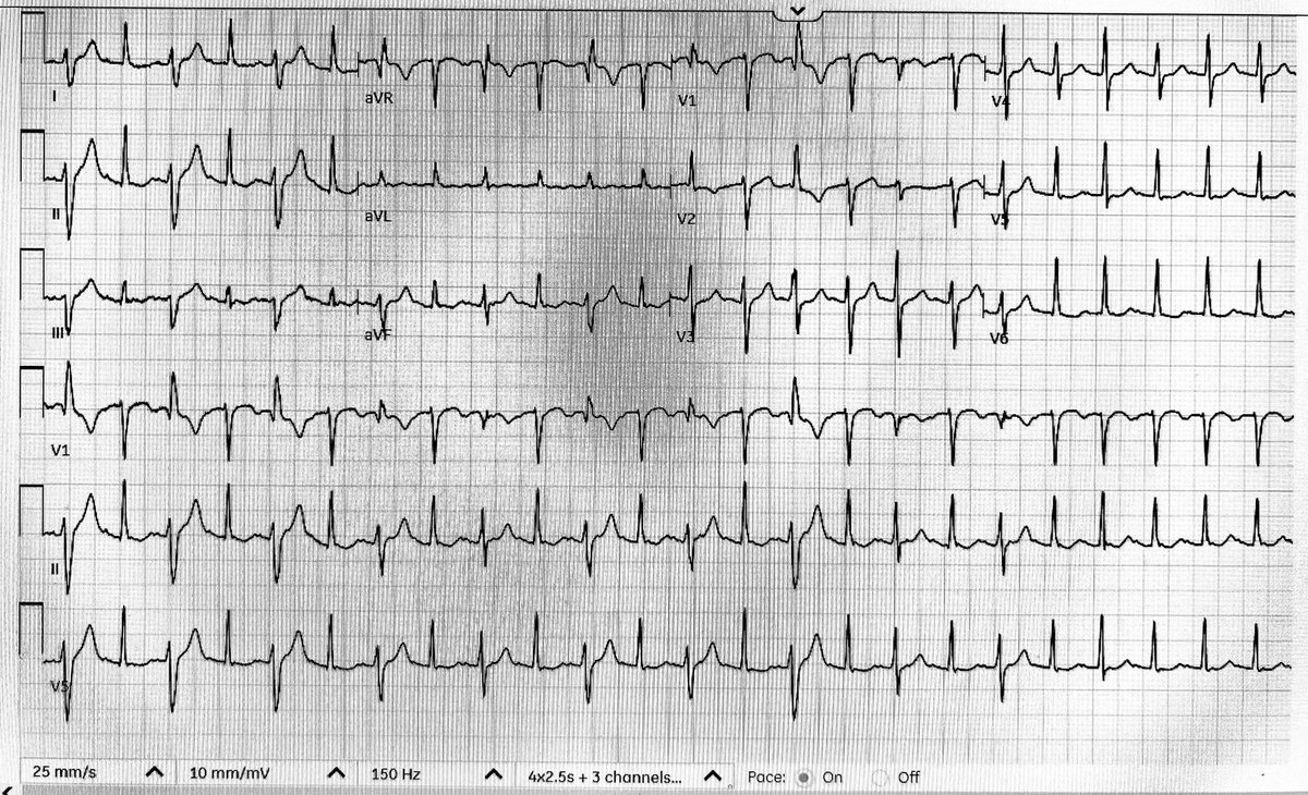 Favorite part of weekend call is finding cool #ECG tracings.