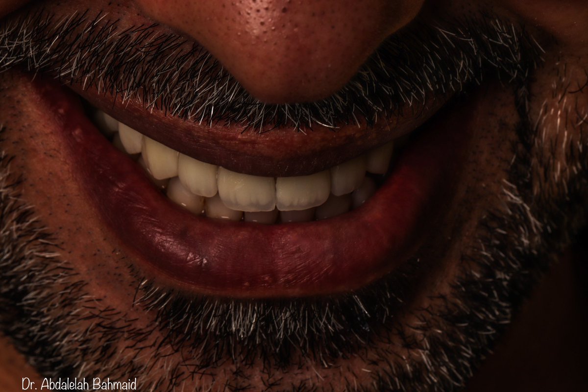 abdalelah_bah's tweet photo. متعة بصرية 😍✨

الحمد لله 🙏🏻.. 

✨ للحجز عن طريق الخاص او الواتس : 0555494002 

✨ او عن طريق مركز الاتصال : 
0112100000

#اكاديميا_كلينيك 
#REU
#علاج_الاسنان https://t.co/DekUIIv2fU