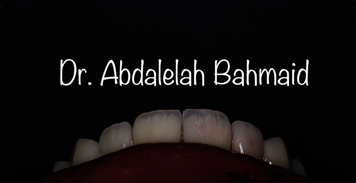 abdalelah_bah's tweet photo. متعة بصرية 😍✨

الحمد لله 🙏🏻.. 

✨ للحجز عن طريق الخاص او الواتس : 0555494002 

✨ او عن طريق مركز الاتصال : 
0112100000

#اكاديميا_كلينيك 
#REU
#علاج_الاسنان https://t.co/DekUIIv2fU
