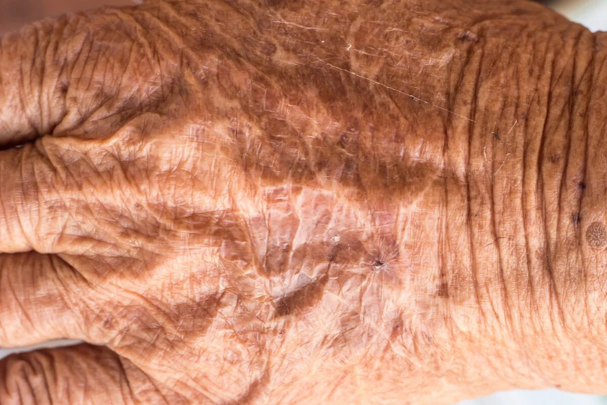 #RenaceLaPatria  El envejecimiento en la piel está relacionado a una proteína
Un equipo de científicos españoles encontró que niveles altos de la proteína IL-17 aceleran el envejecimiento cutáneo @MagalyHenrique7 @LuisAng7899 @GoyoRome @jhonnytw111 @Elamor33073277 @IralisailC