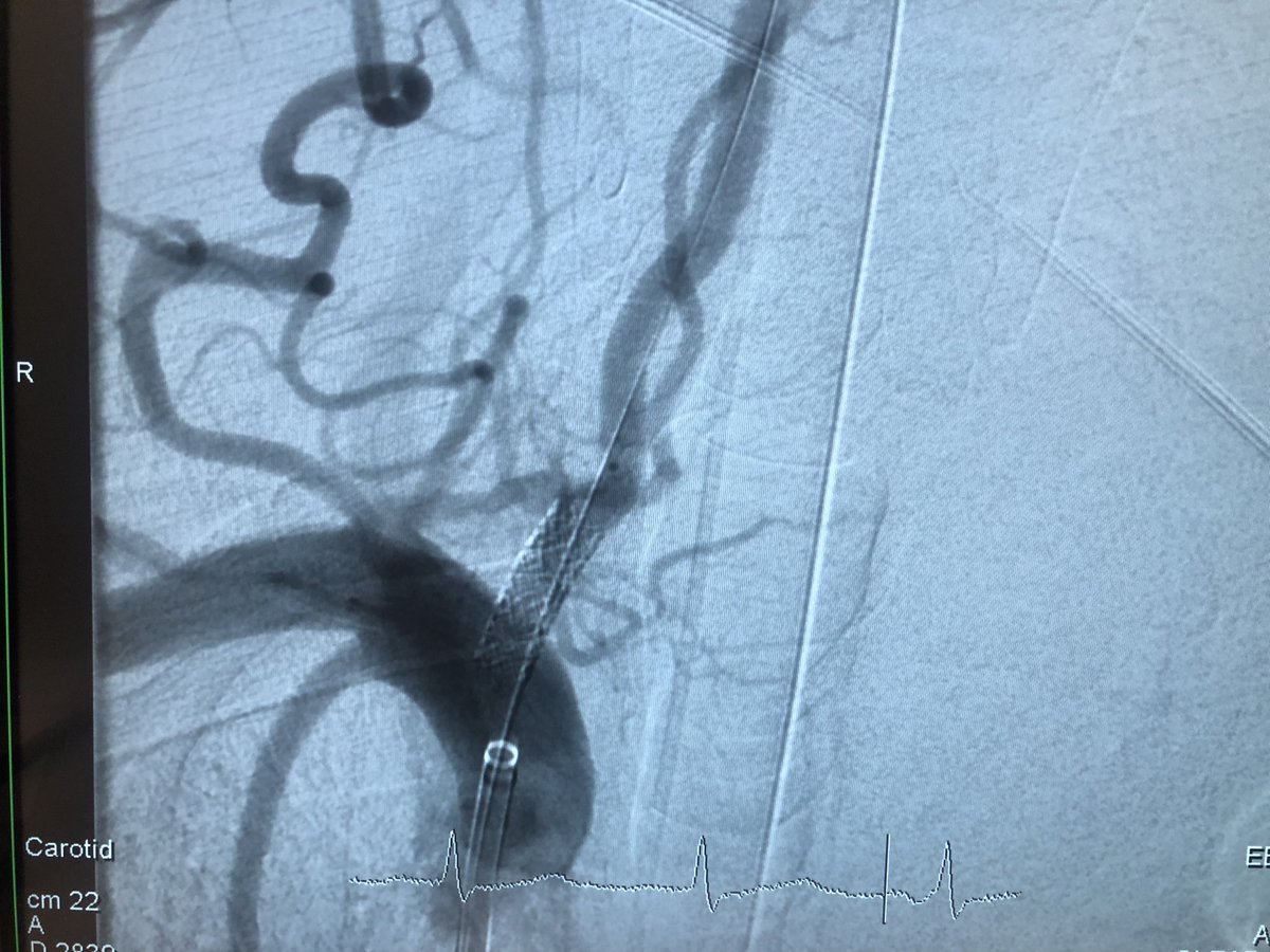 Tandem occlusion in posterior circulation - RVA prox. occl. on atherosclerotic stenosis and BA distal occl. ADAPT in BA (1pass with TICI3-LPCA connected with anter.circul.) then ballon-expand.stent in RVA @SzpitaleP #neurotwitter #thrombectomy #stroke #posteriorcirculaton #BAO