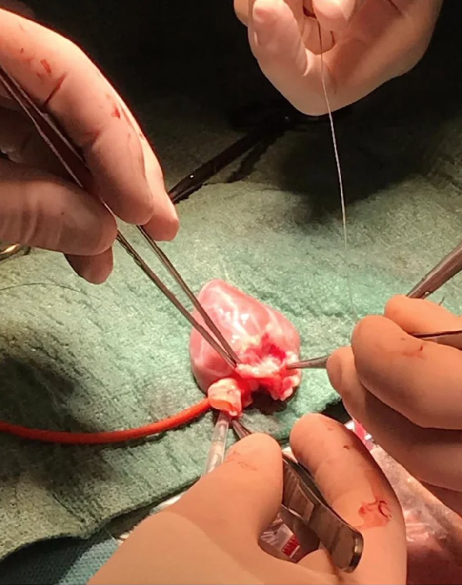 Pediatric Heart Transplant...isn't it so small. Kudos to surgeons, anesthesiologists, nurses and the whole teams who do this great work daily.